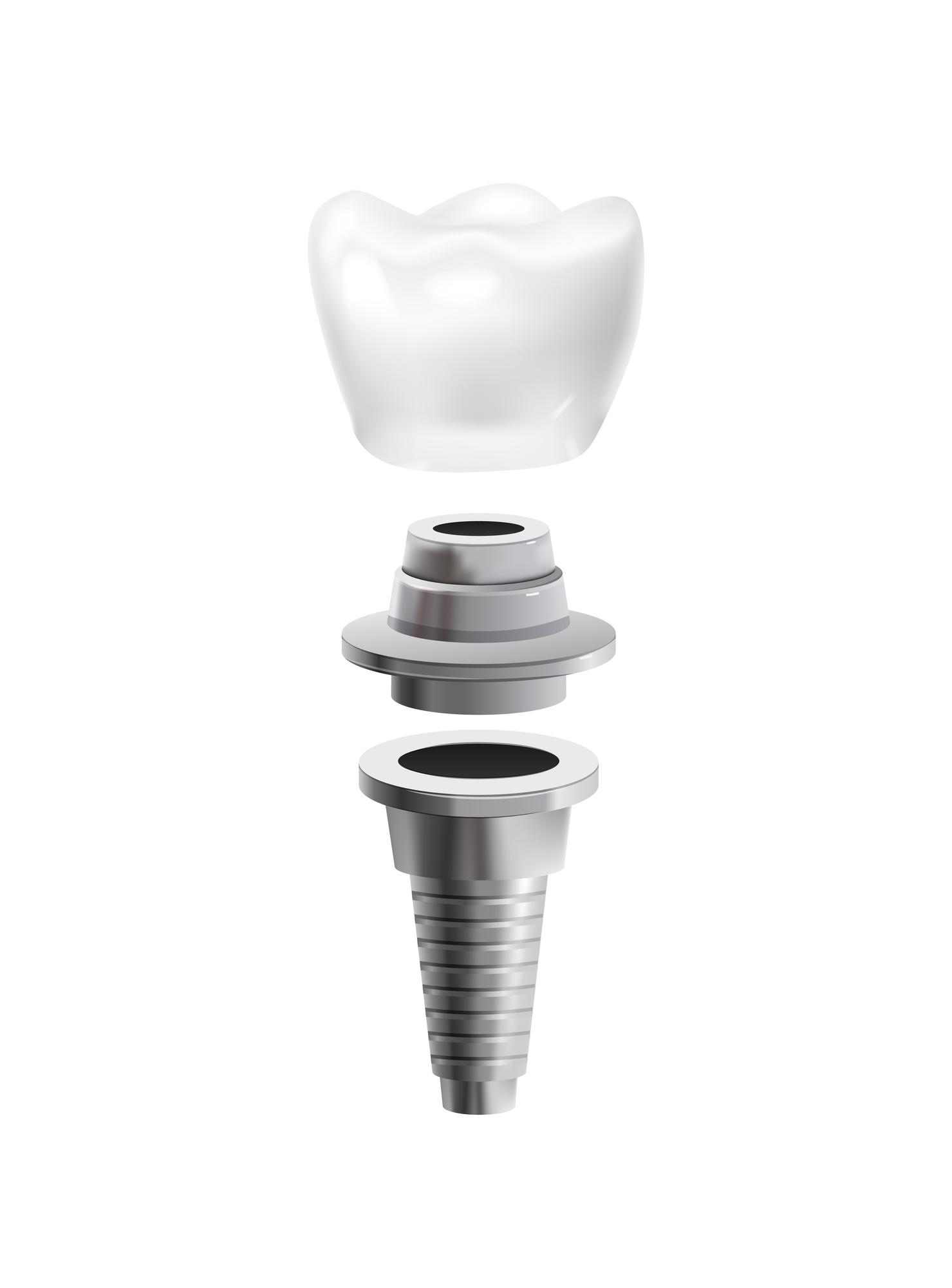 metal-dental-post-realistic-icon-isolated-vector-illustration_1284-66754
